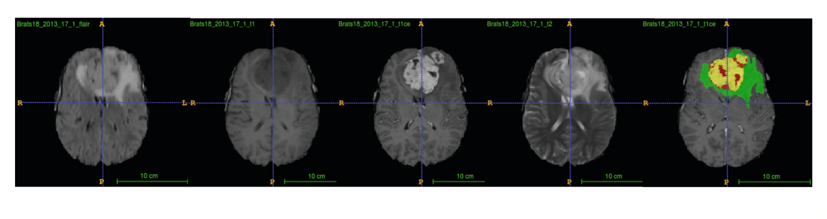 Multimodal MRI with ground truth form BraTS 2018 dataset